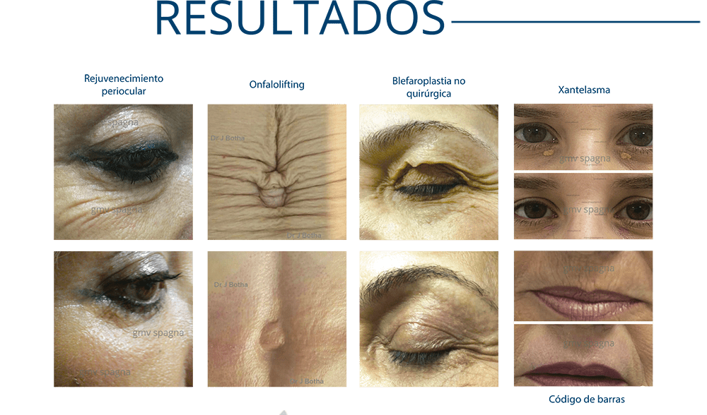 Cirugía Plasma, Resultados de Cirugía Plasma